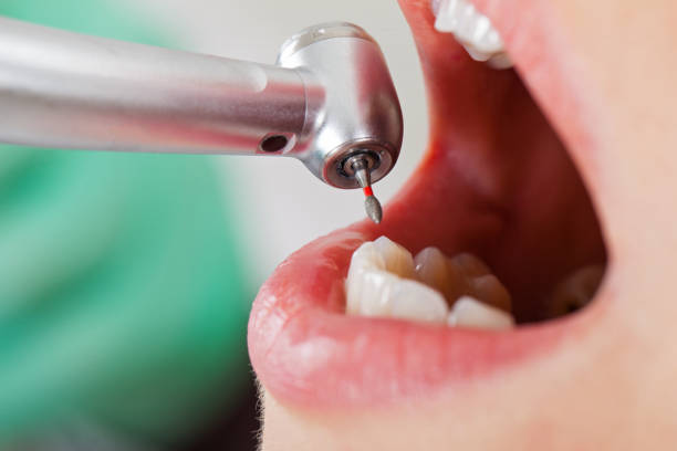 Best Emergency Dentist for Lost Fillings or Crowns in Meriden, CT
